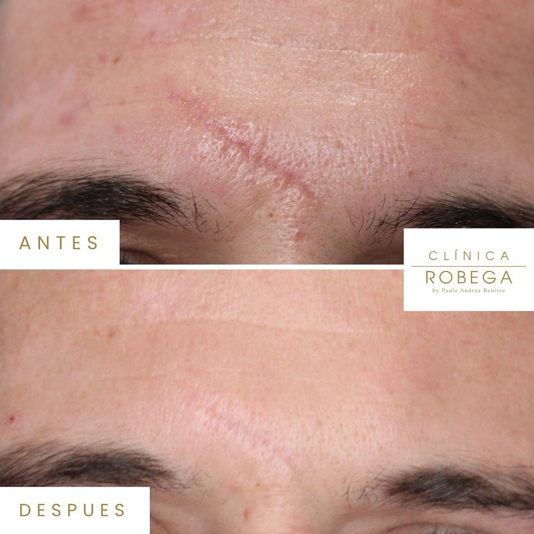 Antes